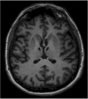 Reduced Self-Awareness Following a Combined Polar and Paramedian Bilateral Thalamic Infarction. A Possible Relationship With SARS-CoV-2 Risk of Contagion?